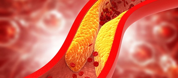 “Colesterol bueno” oxidado se asocia con el aumento de la mortalidad en pacientes con sepsis